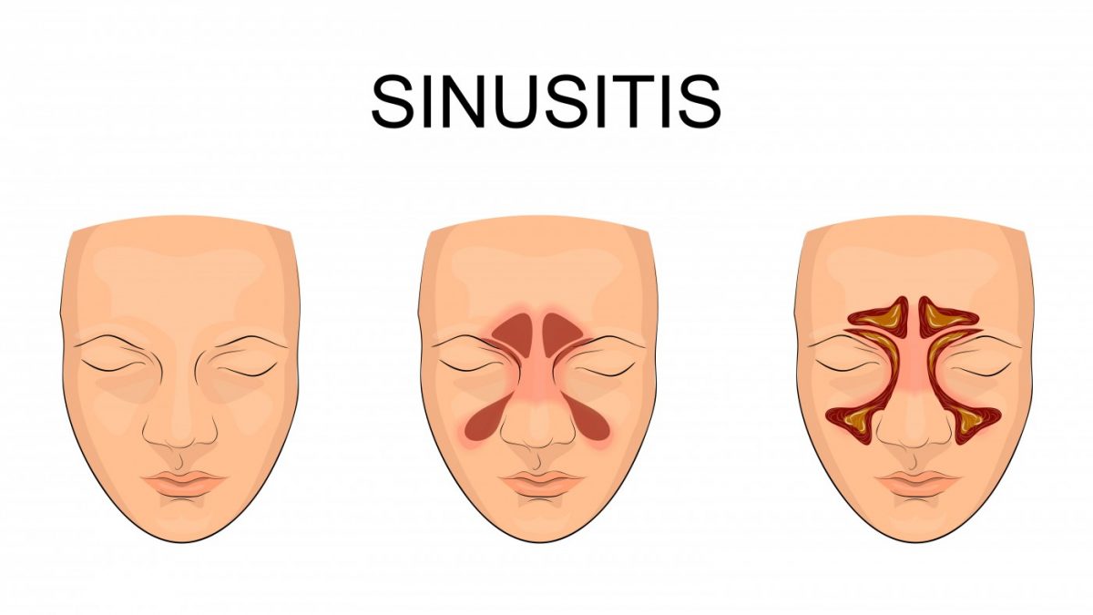 Bronchiectasis In Copd Linked To Sinus Inflammation Study Says