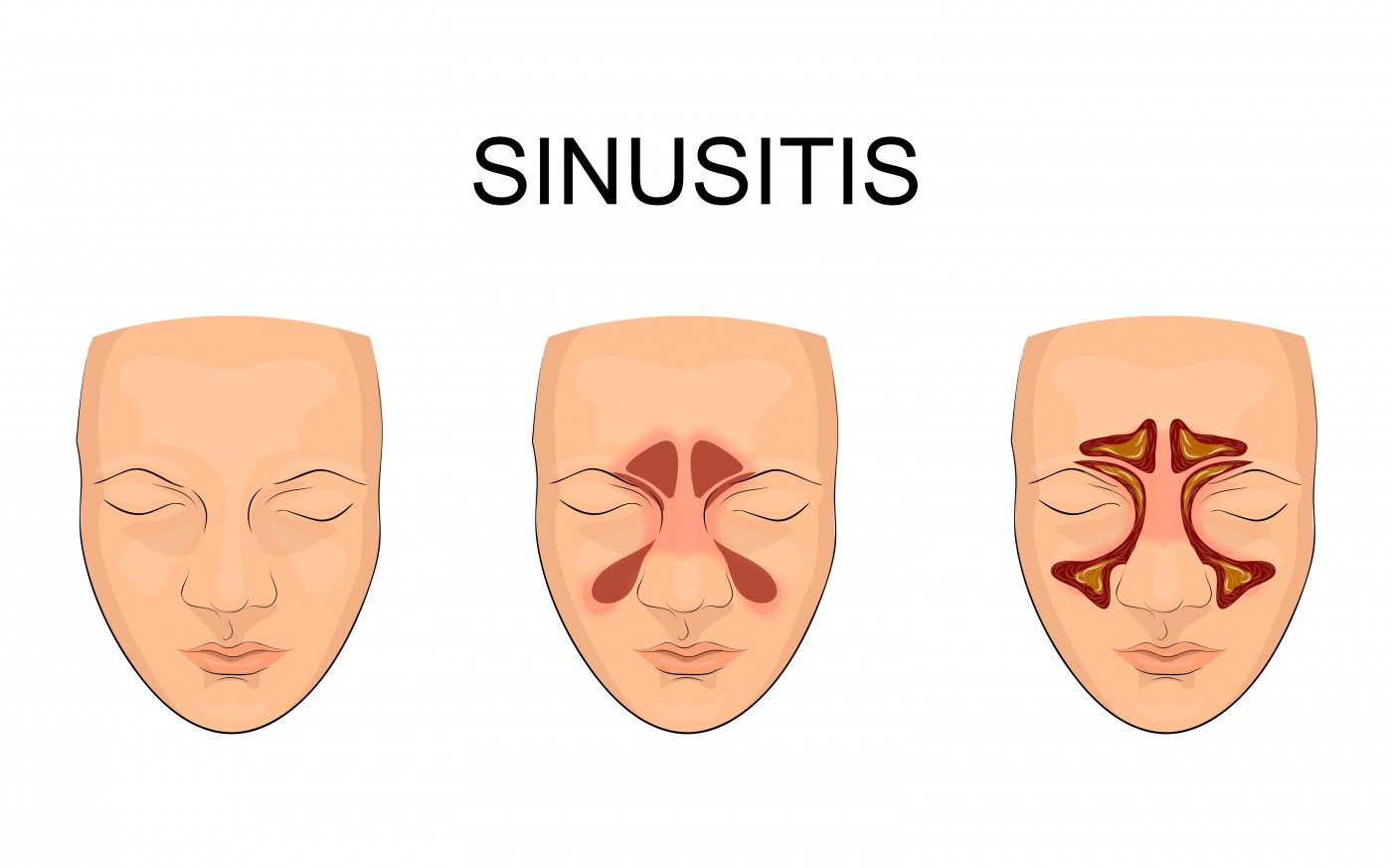 sinusitis