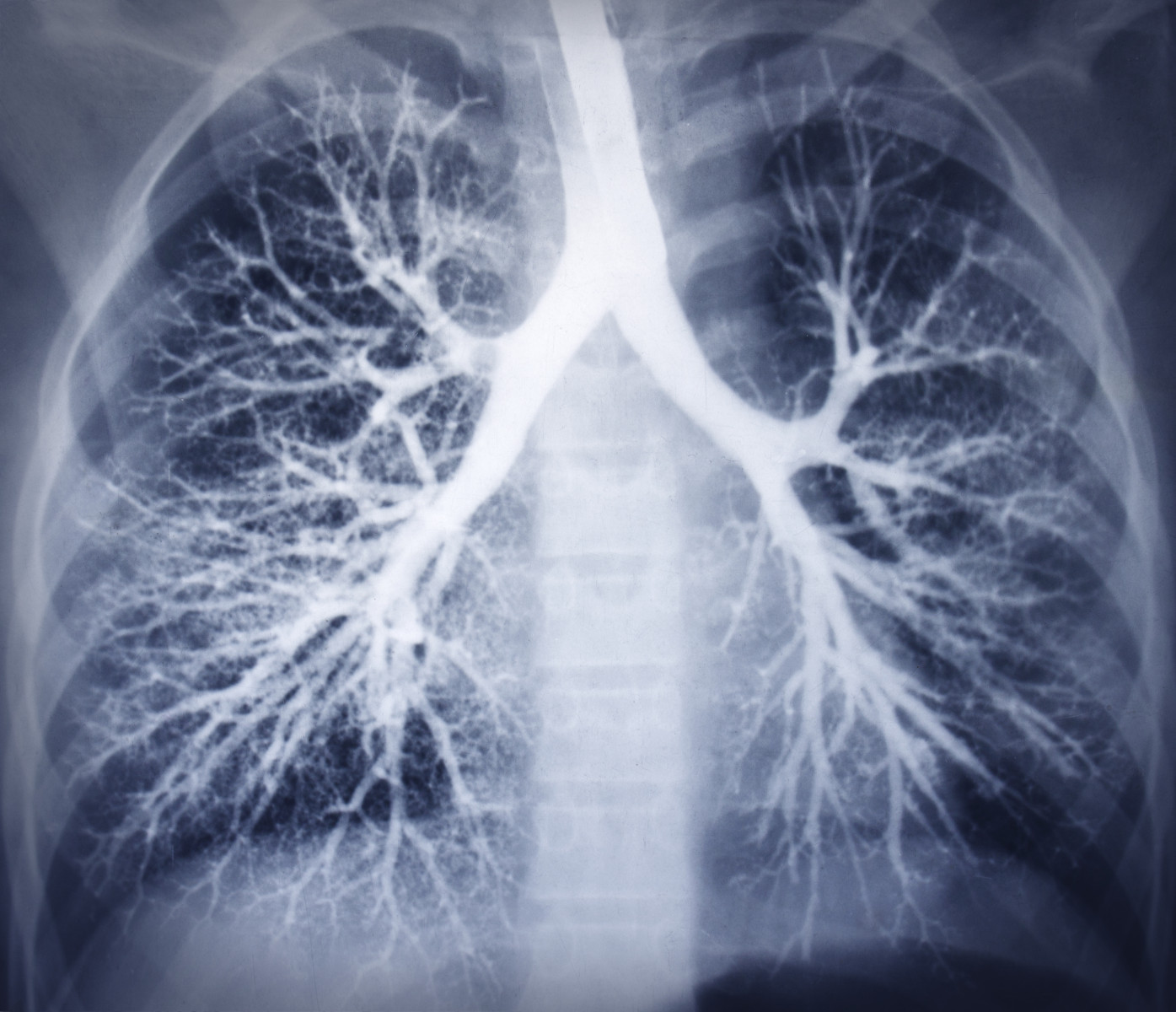 emphysema lung vs normal lung