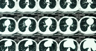 lung cancer rate COPD