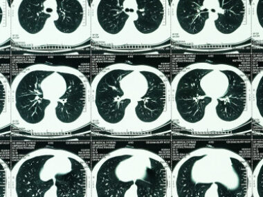 lung cancer rate COPD